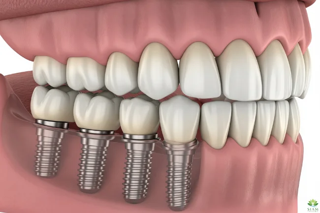 3D illustration of All-on-4 dental implants in the jawbone with a full arch of teeth
