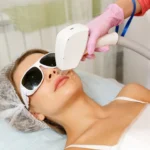 A woman receiving a laser hair removal treatment on her upper lip in a professional clinic. The procedure is being performed with a modern laser device, ensuring precision and comfort.